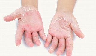 जाडोमा छालाको समस्याले हैरान हुनुहुन्छ ? यस्ता छन् घरेलु उपचार विधि