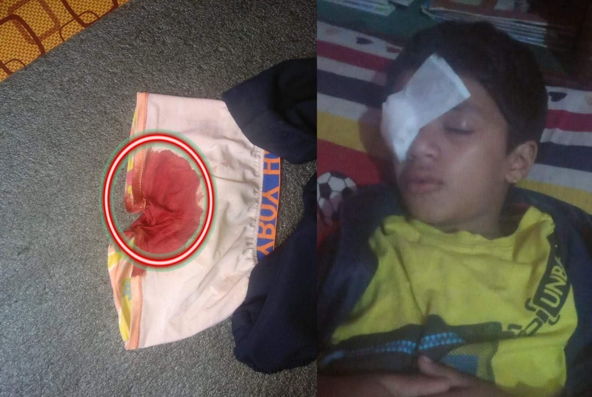 विद्यालयको कमजोरी कारण बागलुङमा दुई विद्यार्थीको अण्डकोष र आँखामा गम्भीर चोट